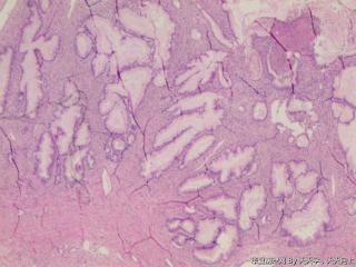 右卵巢巨大肿瘤图14