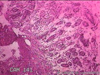 胃窦后壁粘膜图16