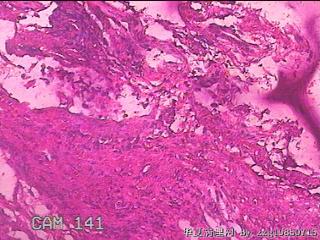 胃窦前壁粘膜图44