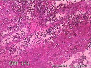 胃窦前壁粘膜图31