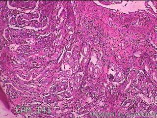 胃窦前壁粘膜图21