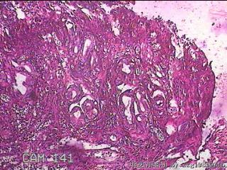 胃窦前壁粘膜图27