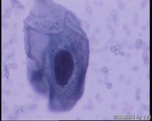 上皮细胞量少，仅见以下五个异常细胞，怎样诊断合适？图4