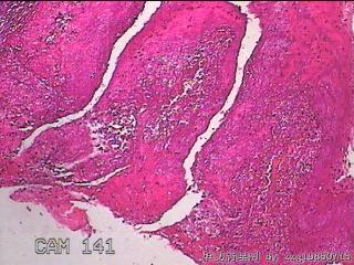 右侧鼻腔中鼻道新生物图31