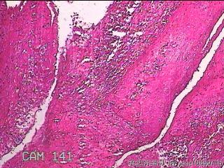 右侧鼻腔中鼻道新生物图35