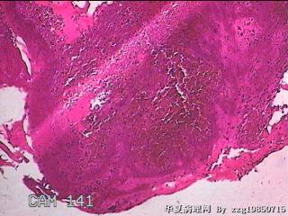 右侧鼻腔中鼻道新生物图28