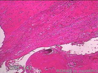 右侧鼻腔中鼻道新生物图45