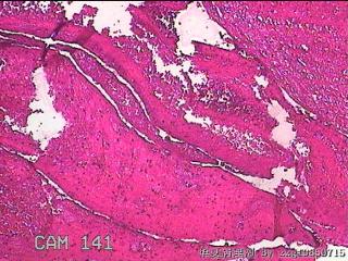 右侧鼻腔中鼻道新生物图14