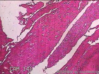 右侧鼻腔中鼻道新生物图34