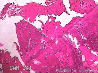 右侧鼻腔中鼻道新生物图30