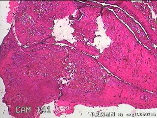 右侧鼻腔中鼻道新生物图15