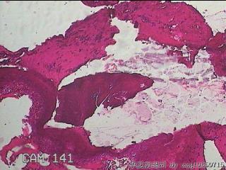 右侧鼻腔中鼻道新生物图3