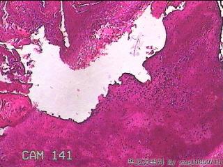 右侧鼻腔中鼻道新生物图26