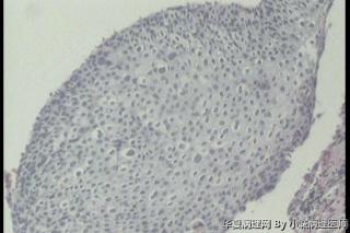 36岁宫颈活检，报高级别累腺吗？还是CIN III累腺图12