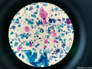 44岁，印戒样细胞、空泡等，无节育环图9