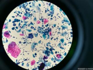 44岁，印戒样细胞、空泡等，无节育环图12