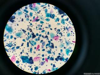 44岁，印戒样细胞、空泡等，无节育环图11