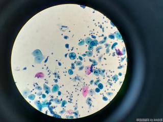 44岁，印戒样细胞、空泡等，无节育环图7