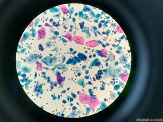 44岁，印戒样细胞、空泡等，无节育环图3
