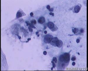 请教：宫颈液基，HPV阴性，细胞量少，退变？图16