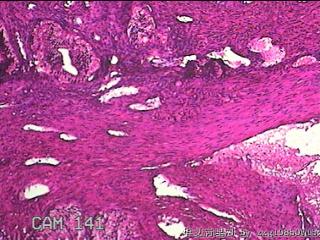 宫颈赘生物图32