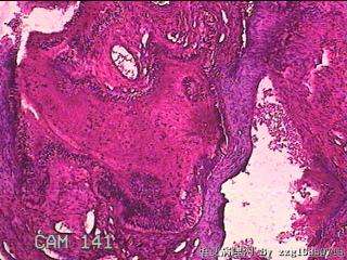 宫颈赘生物图8