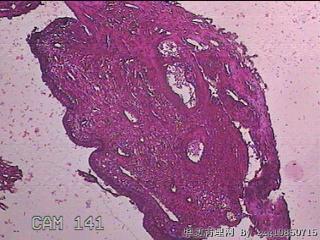 宫颈息肉图11
