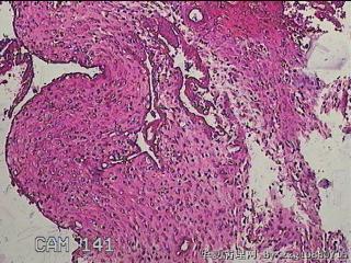 宫腔组织图50