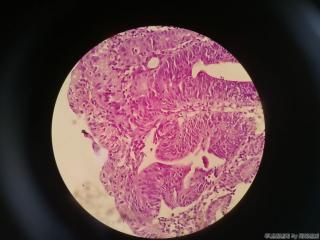 胃窦前壁粘膜图28