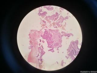胃窦前壁粘膜图6