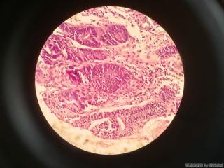 胃窦前壁粘膜图11