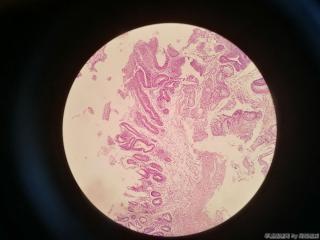 胃窦前壁粘膜图4