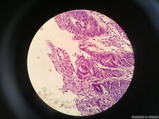 胃窦前壁粘膜图12