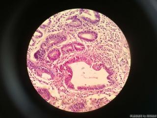 胃窦前壁粘膜图14