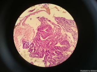 胃窦前壁粘膜图24