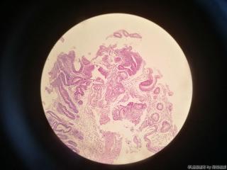 胃窦前壁粘膜图5