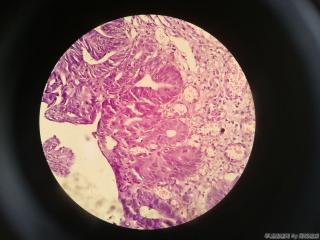胃窦前壁粘膜图23