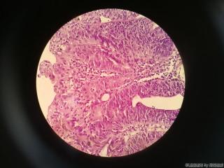 胃窦前壁粘膜图29
