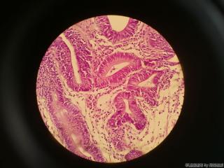 胃窦前壁粘膜图16