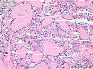 甲状腺腺瘤？图8