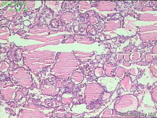 甲状腺腺瘤？图2