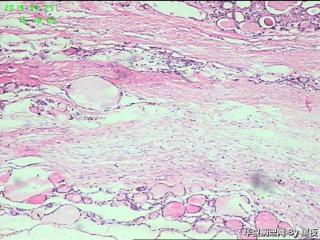 甲状腺腺瘤？图1