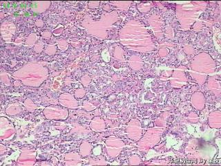 甲状腺腺瘤？图3