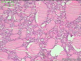 甲状腺腺瘤？图4