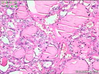 甲状腺腺瘤？图5