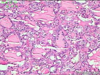 甲状腺腺瘤？图7