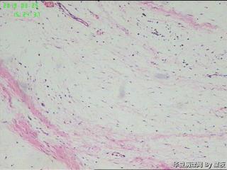 大腿肿物，请教？图1