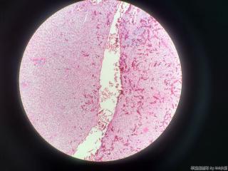 胆囊浆膜面赘生物图5