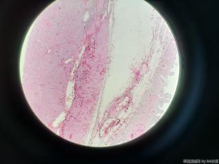 胆囊浆膜面赘生物图2