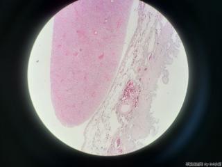 胆囊浆膜面赘生物图1